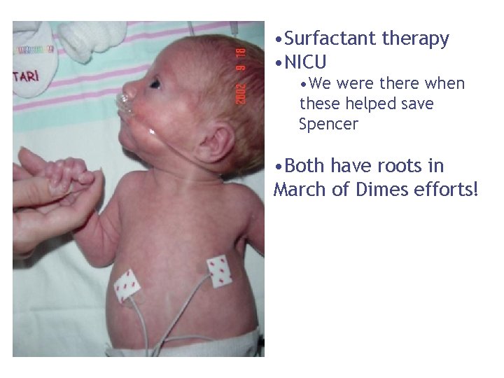  • Surfactant therapy • NICU • We were there when these helped save