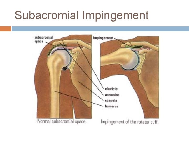 Subacromial Impingement 