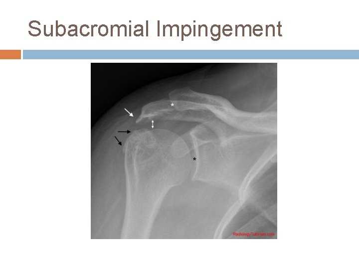 Subacromial Impingement 