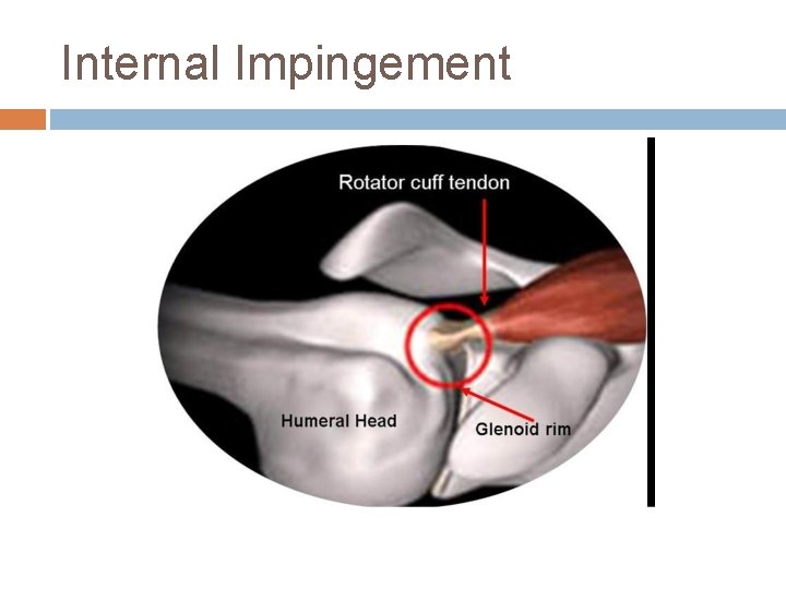 Internal Impingement 