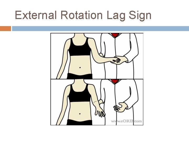 External Rotation Lag Sign 