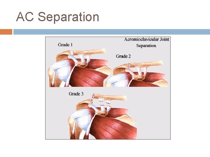 AC Separation 