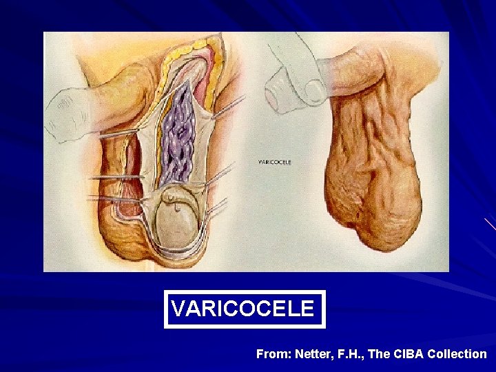 VARICOCELE From: Netter, F. H. , The CIBA Collection 