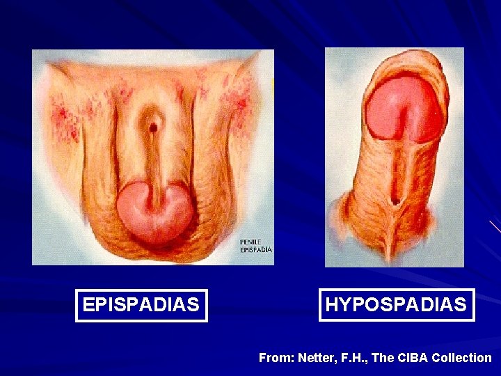 EPISPADIAS HYPOSPADIAS From: Netter, F. H. , The CIBA Collection 