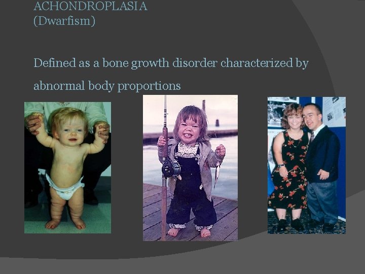 ACHONDROPLASIA (Dwarfism) Defined as a bone growth disorder characterized by abnormal body proportions 