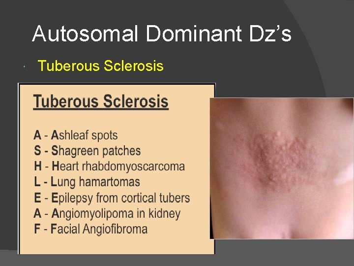 Autosomal Dominant Dz’s Tuberous Sclerosis 