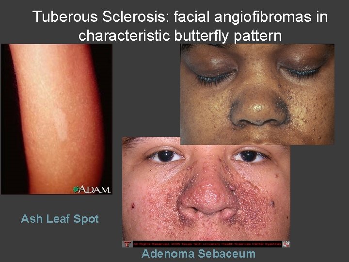 Tuberous Sclerosis: facial angiofibromas in characteristic butterfly pattern Ash Leaf Spot Adenoma Sebaceum 