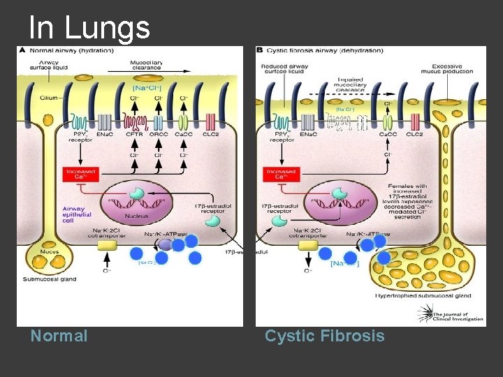 In Lungs Normal Cystic Fibrosis 