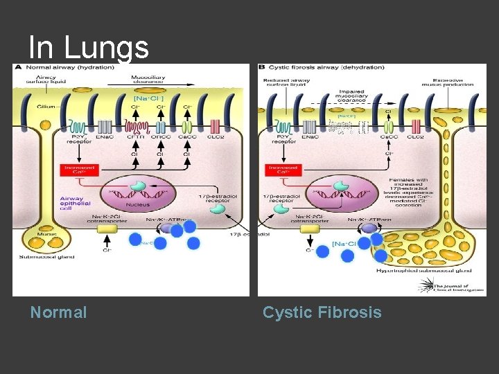 In Lungs Normal Cystic Fibrosis 