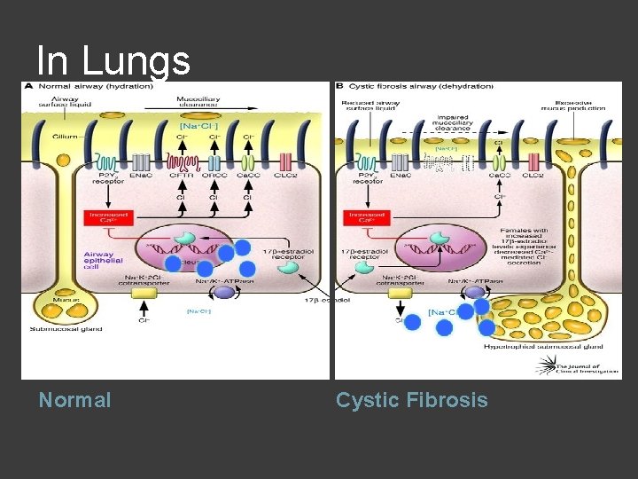 In Lungs Normal Cystic Fibrosis 