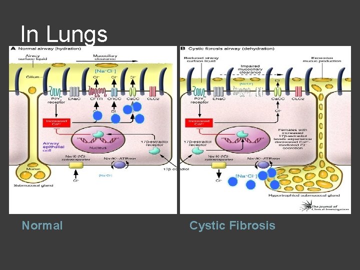 In Lungs Normal Cystic Fibrosis 