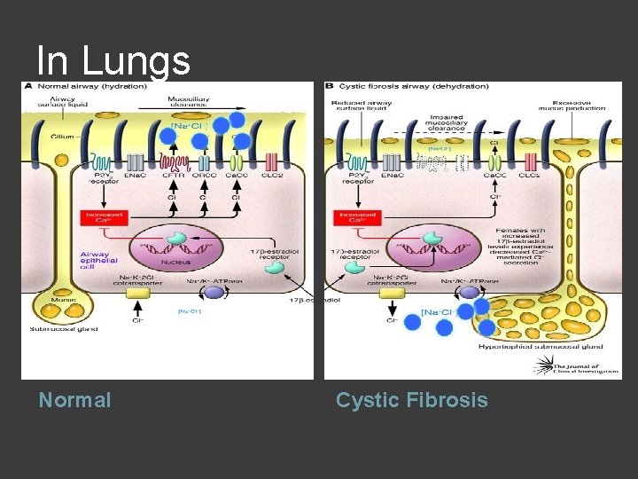 In Lungs Normal Cystic Fibrosis 