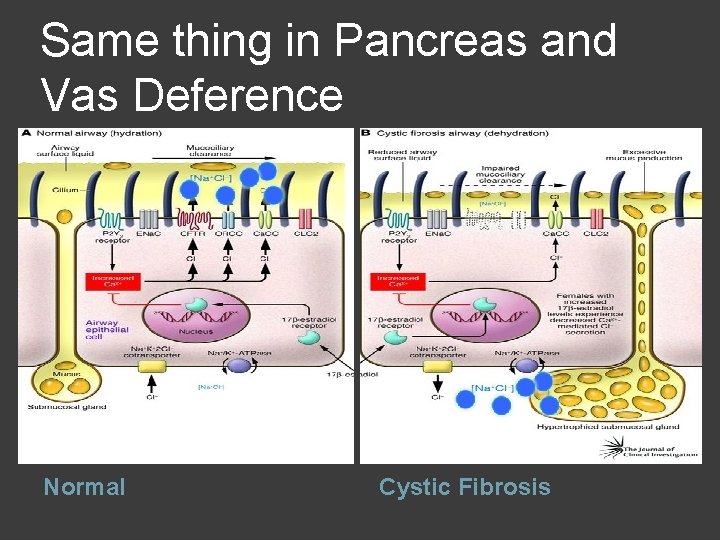 Same thing in Pancreas and Vas Deference Normal Cystic Fibrosis 