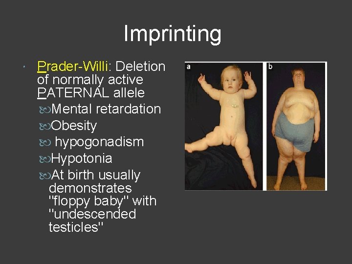 Imprinting Prader-Willi: Deletion of normally active PATERNAL allele Mental retardation Obesity hypogonadism Hypotonia At