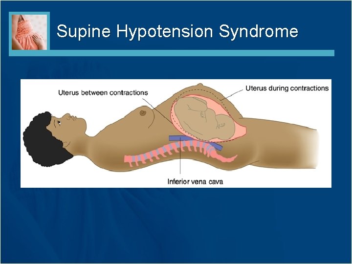 Supine Hypotension Syndrome 