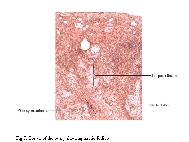 Fig 7: Cortex of the ovary showing atretic follicle 