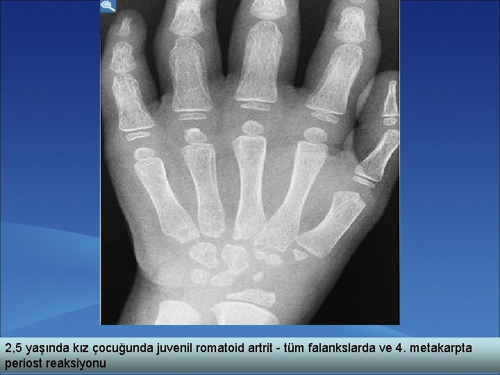 2, 5 yaşında kız çocuğunda juvenil romatoid artrit - tüm falankslarda ve 4. metakarpta