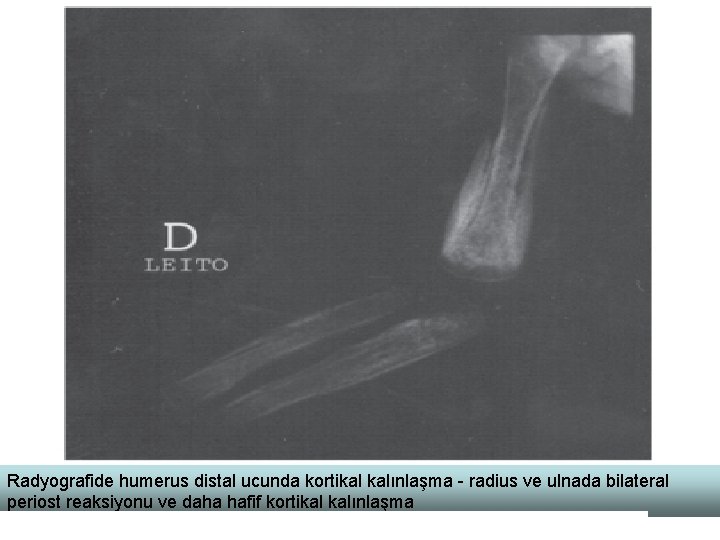 Radyografide humerus distal ucunda kortikal kalınlaşma - radius ve ulnada bilateral periost reaksiyonu ve