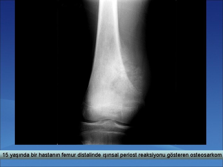 15 yaşında bir hastanın femur distalinde ışınsal periost reaksiyonu gösteren osteosarkom 