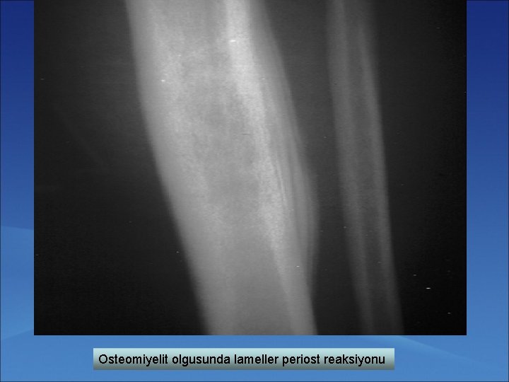 Osteomiyelit olgusunda lameller periost reaksiyonu 