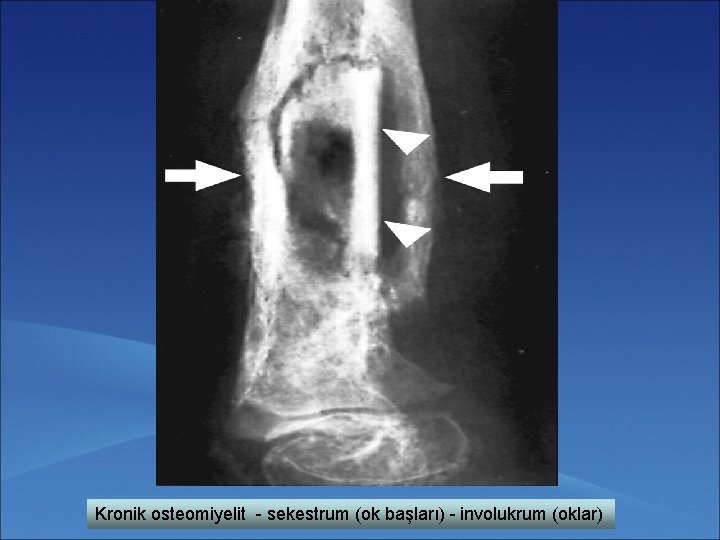 Kronik osteomiyelit - sekestrum (ok başları) - involukrum (oklar) 
