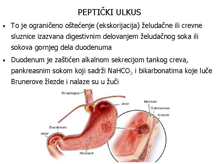 PEPTIČKI ULKUS • To je ograničeno oštećenje (ekskorijacija) želudačne ili crevne sluznice izazvana digestivnim