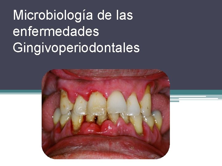 Microbiología de las enfermedades Gingivoperiodontales 