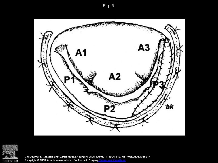 Fig. 5 The Journal of Thoracic and Cardiovascular Surgery 2000 120409 -411 DOI: (10.