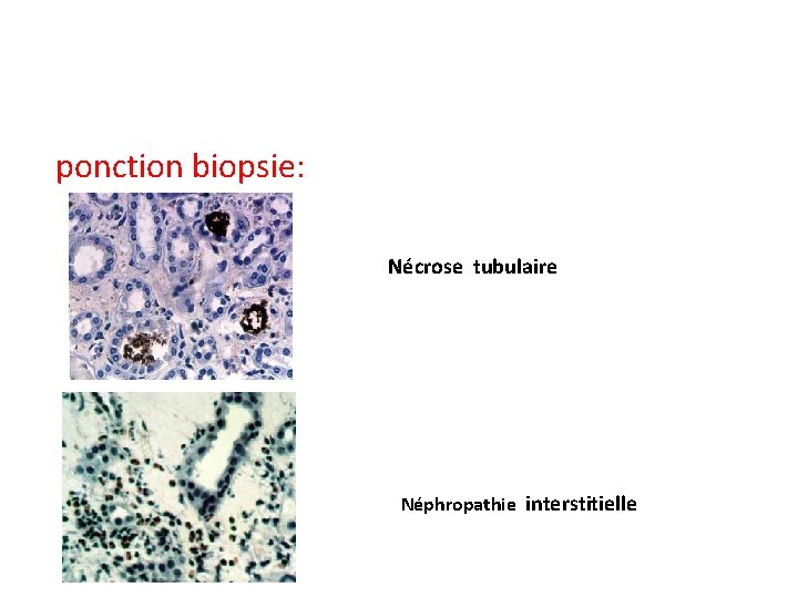 ponction biopsie: Nécrose tubulaire Néphropathie interstitielle 