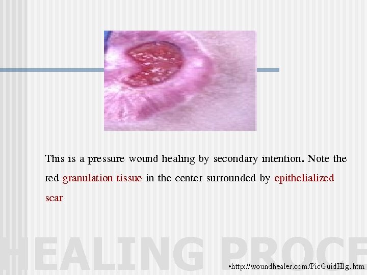 This is a pressure wound healing by secondary intention. Note the red granulation tissue