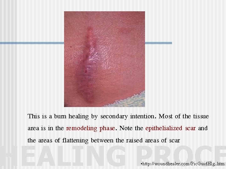 This is a burn healing by secondary intention. Most of the tissue area is