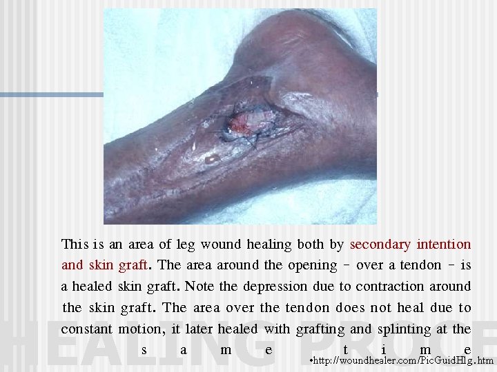 This is an area of leg wound healing both by secondary intention and skin