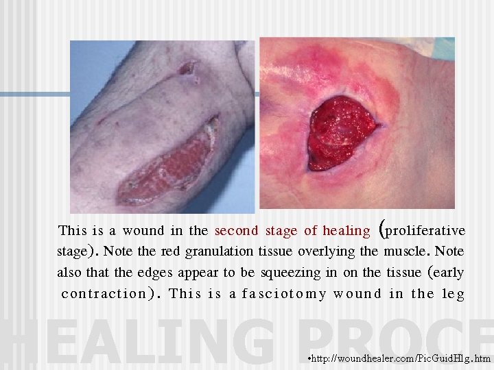 This is a wound in the second stage of healing (proliferative stage). Note the