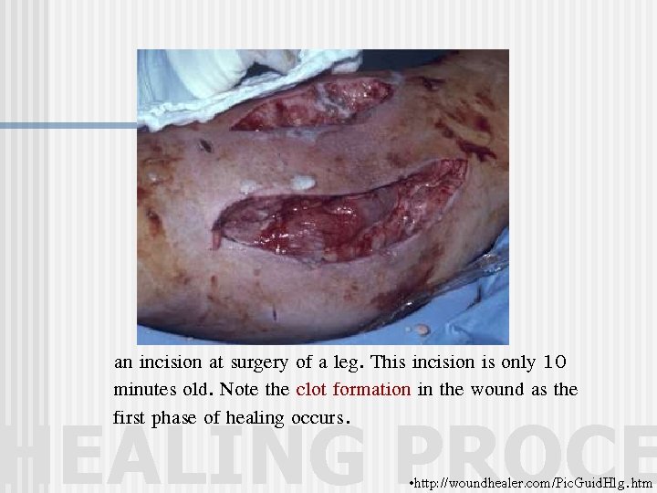 an incision at surgery of a leg. This incision is only 10 minutes old.