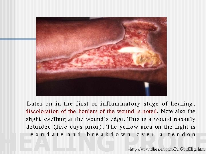 Later on in the first or inflammatory stage of healing, discoloration of the borders