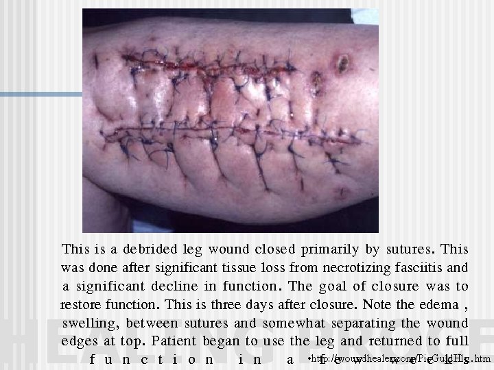 This is a debrided leg wound closed primarily by sutures. This was done after