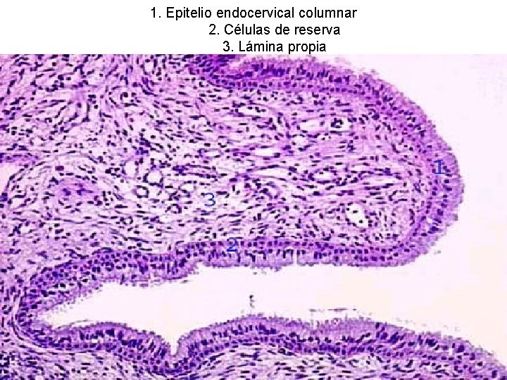 1. Epitelio endocervical columnar 2. Células de reserva 3. Lámina propia 