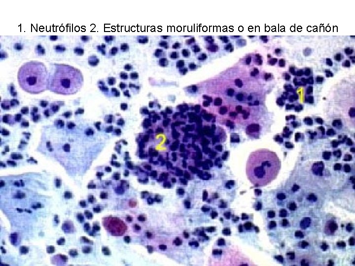 1. Neutrófilos 2. Estructuras moruliformas o en bala de cañón 