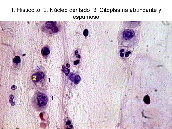 1. Histiocito 2. Núcleo dentado 3. Citoplasma abundante y espumoso 