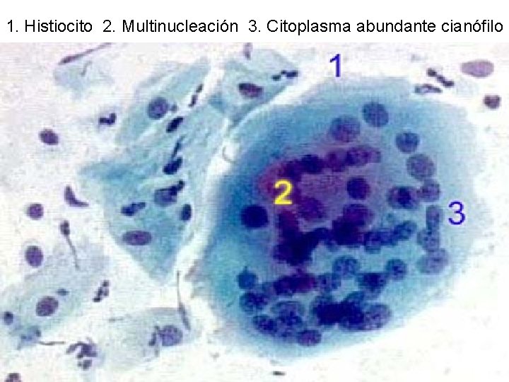 1. Histiocito 2. Multinucleación 3. Citoplasma abundante cianófilo 