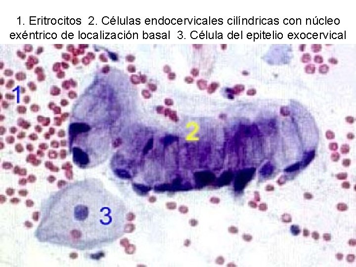 1. Eritrocitos 2. Células endocervicales cilíndricas con núcleo exéntrico de localización basal 3. Célula