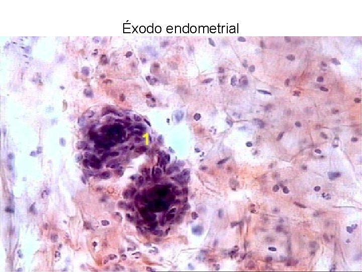 Éxodo endometrial 