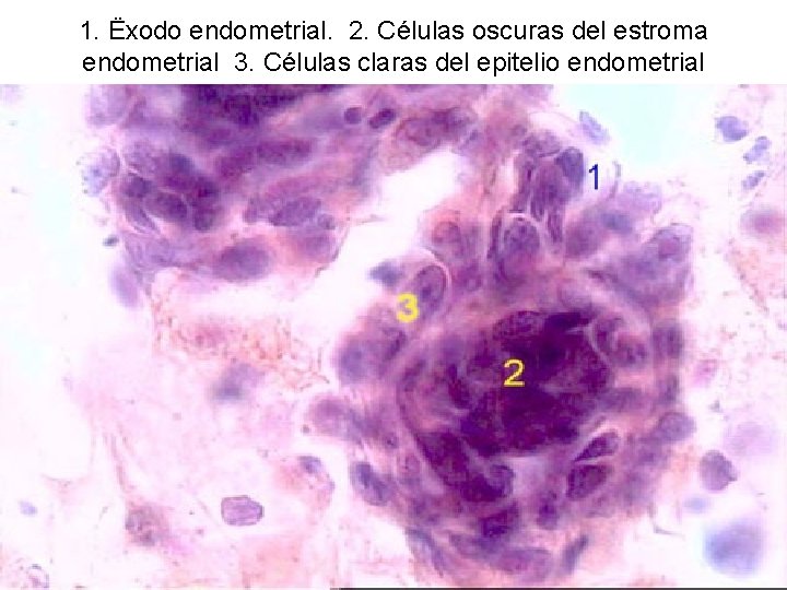 1. Ëxodo endometrial. 2. Células oscuras del estroma endometrial 3. Células claras del epitelio