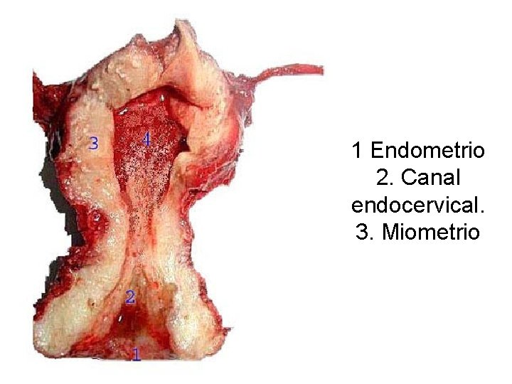 1 Endometrio 2. Canal endocervical. 3. Miometrio 