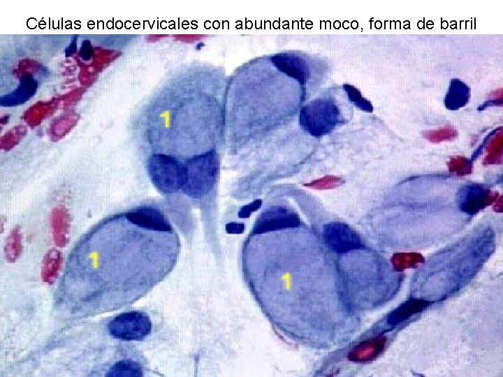 Células endocervicales con abundante moco, forma de barril 