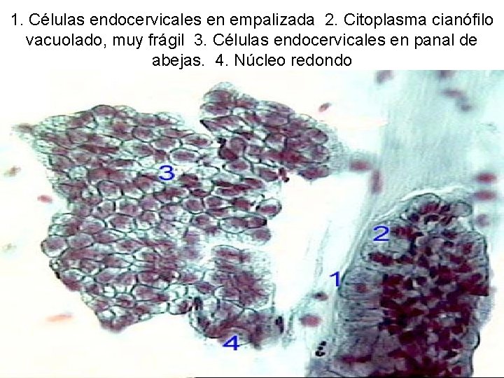 1. Células endocervicales en empalizada 2. Citoplasma cianófilo vacuolado, muy frágil 3. Células endocervicales
