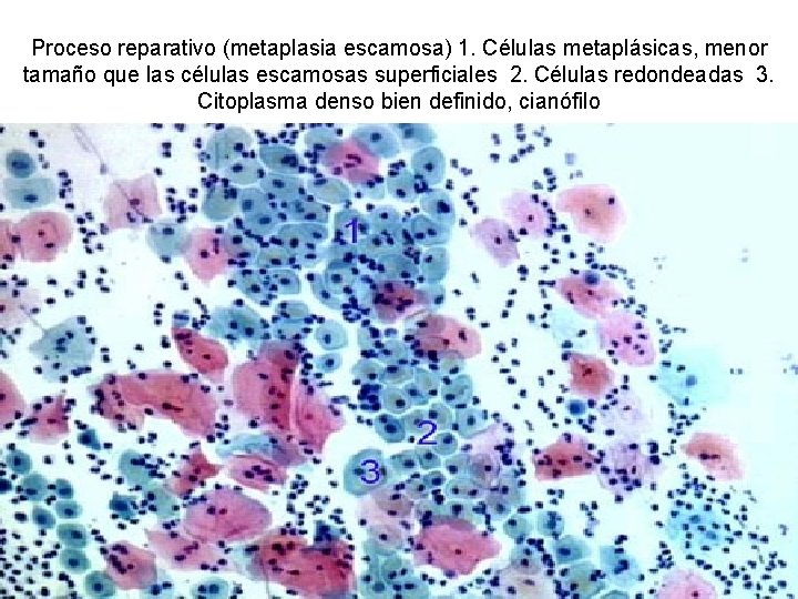 Proceso reparativo (metaplasia escamosa) 1. Células metaplásicas, menor tamaño que las células escamosas superficiales