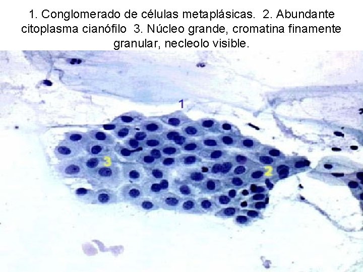 1. Conglomerado de células metaplásicas. 2. Abundante citoplasma cianófilo 3. Núcleo grande, cromatina finamente