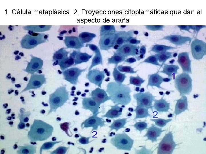 1. Célula metaplásica 2. Proyecciones citoplamáticas que dan el aspecto de araña 