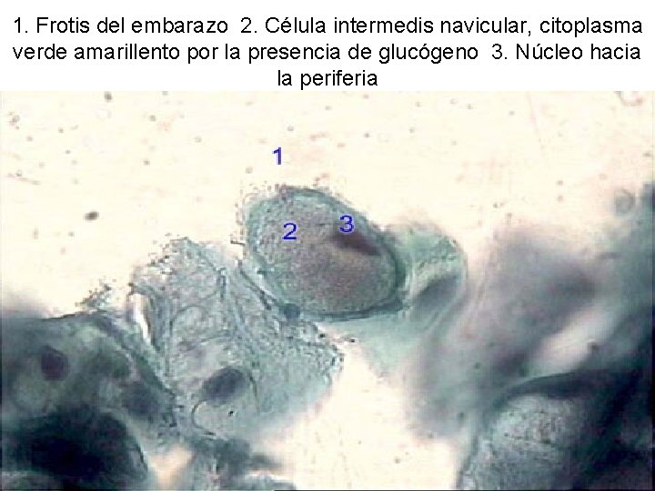 1. Frotis del embarazo 2. Célula intermedis navicular, citoplasma verde amarillento por la presencia